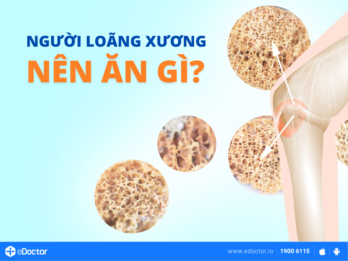 Người loãng xương nên ăn gì?