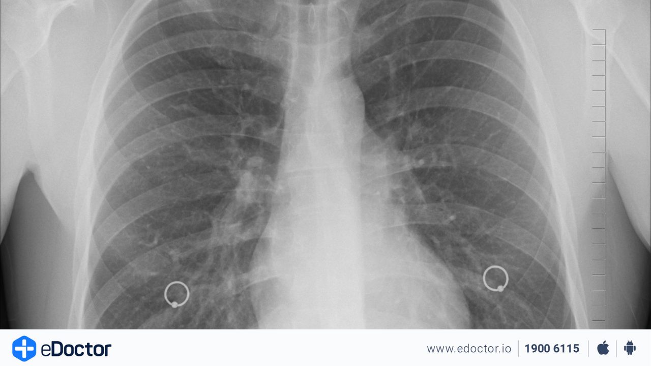 Ô nhiễm không khí và các bệnh đường hô hấp